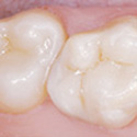 Tooth Colored Fillings Thumbnail